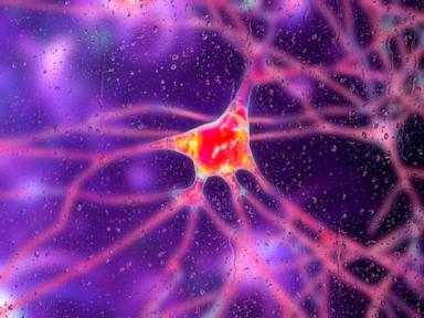 Preliminary gene therapy shows 75% reduction in Huntington’s disease progression