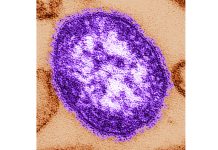 Pennsylvania says an unvaccinated woman has died from measles-related complications Electron microscope image of a measles virus particle. (Cynthia Goldsmith/Centers for Disease Control and Prevention, via AP, File)